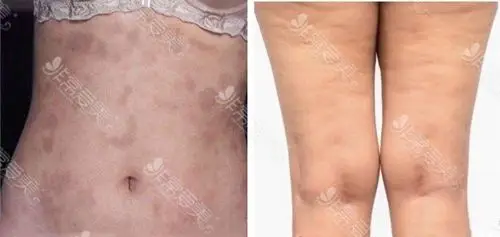 吸脂失败的后果