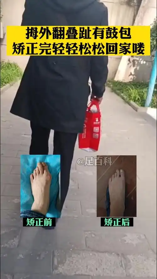 拇外翻叠趾有鼓包,矫正完轻轻松松回家喽!