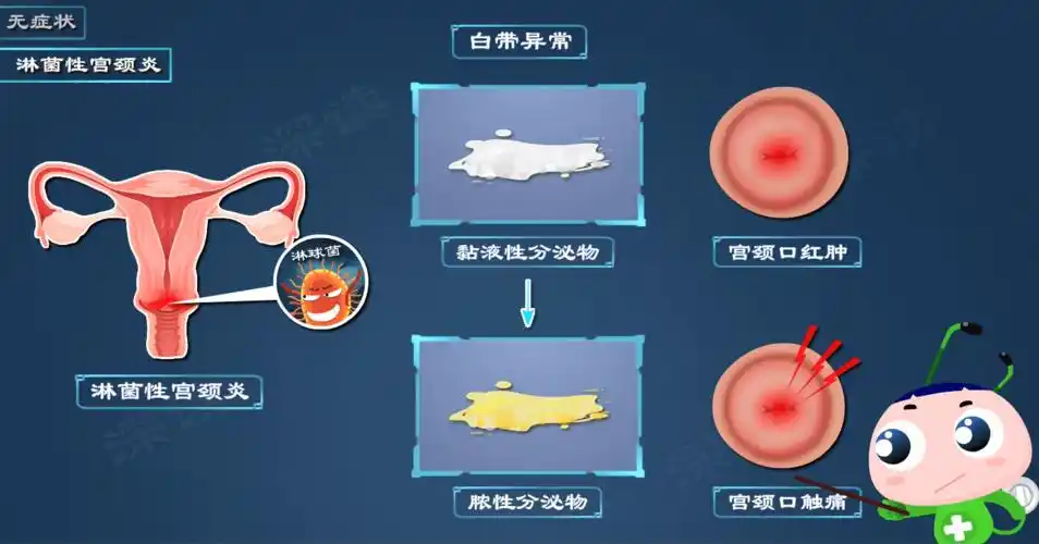 女性淋病最常表现为淋菌性宫颈炎.