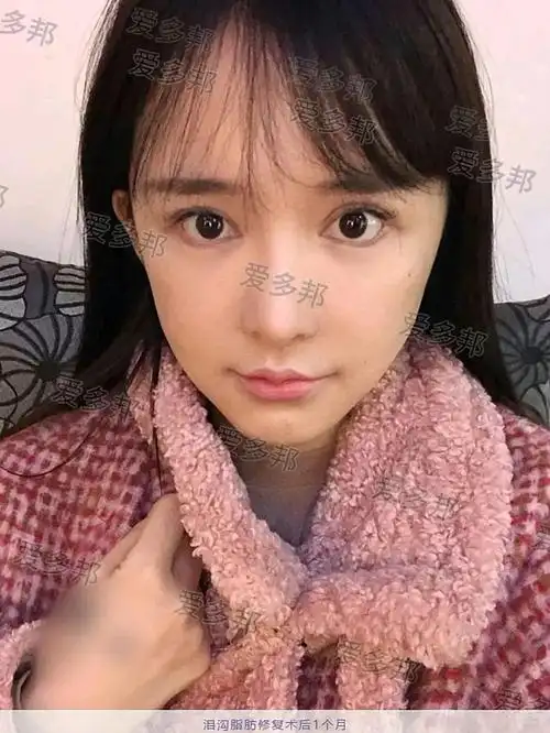 泪沟自体脂肪填充失败修复术后反馈!