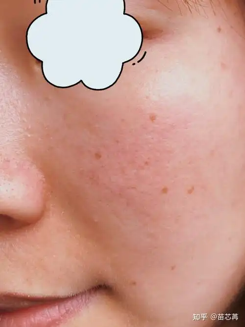 脸上角质层薄,特别容易脸红,怎么办?有好用的护肤品么? - 知乎