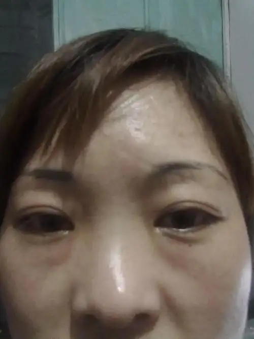 下眼睑浮肿,看着比脸高出一块,是眼袋吗?