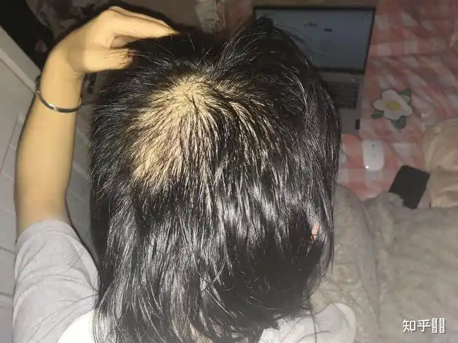 有拔毛癖的老铁们克服了吗