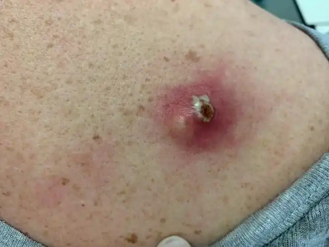 皮肤囊肿图片 (30)_有来医生