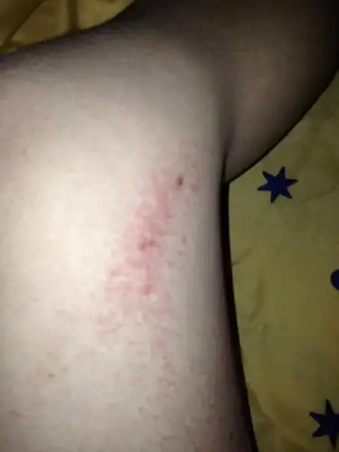 疥疮好了.大腿两侧长这个是什么.有时痛