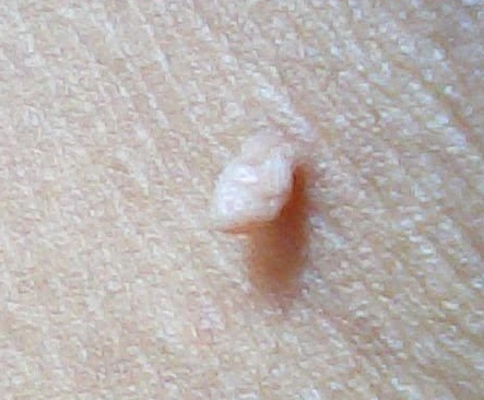 丝状疣会不会传染_疣_介绍_治疗方式 - 好大夫在线