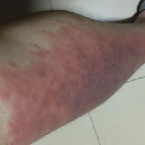 小腿皮肤过敏肿了又痒又疼怎么办