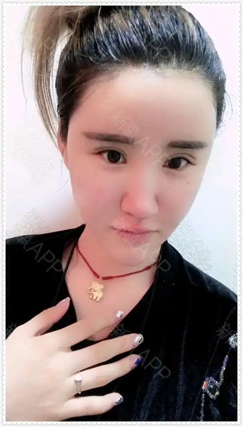 自体脂肪填充全脸,术后一个月脂肪移植效果,是不是很_圈子-新氧美容