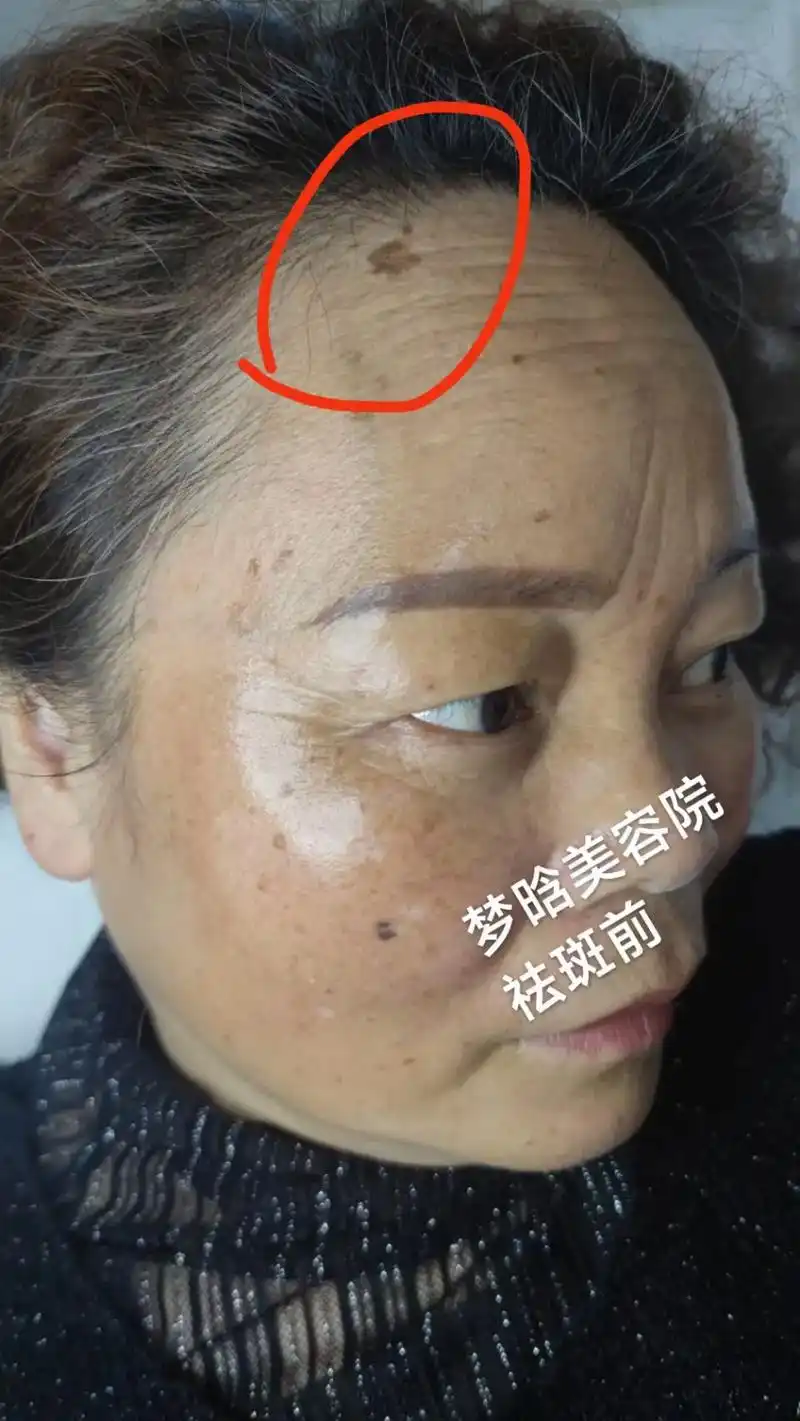 修复后角质层明显变厚了