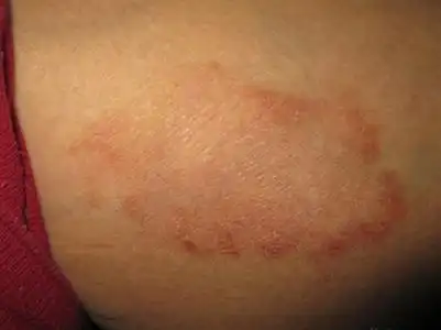 体股癣初期现象图片8