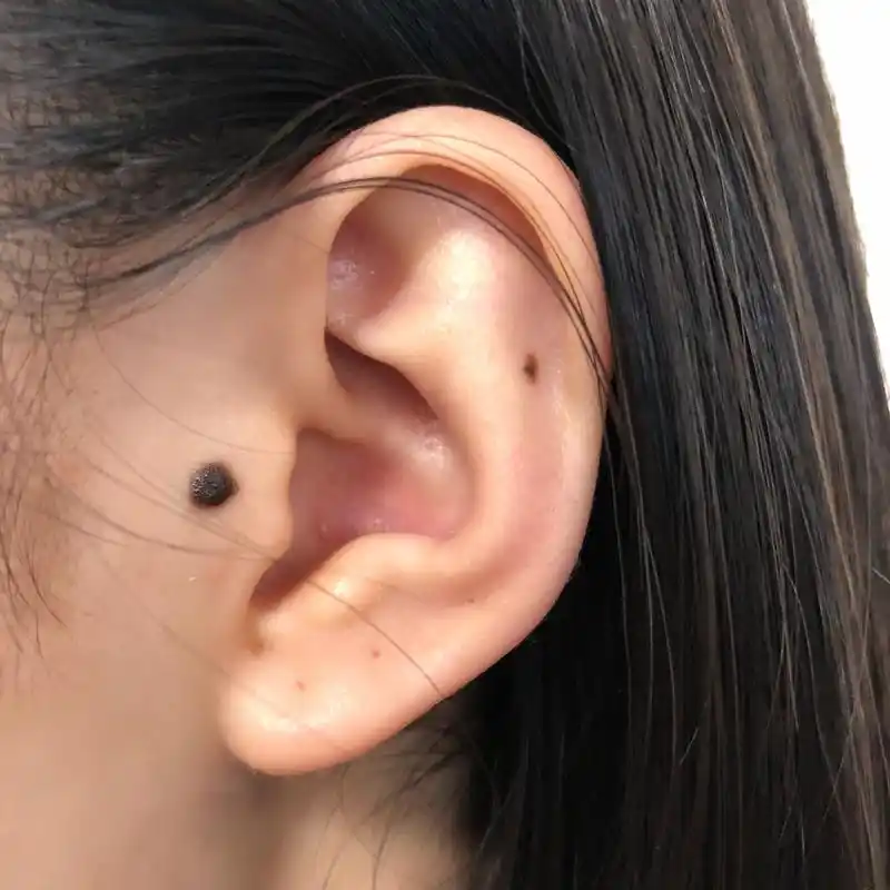 耳朵大肉痣 要去切掉嘛 会不会病变?