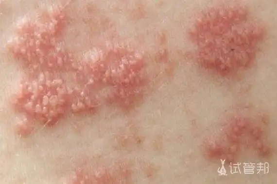 艾滋病初期小红点照片 多久出现