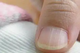 注意这几大癌症都表现在指甲上了