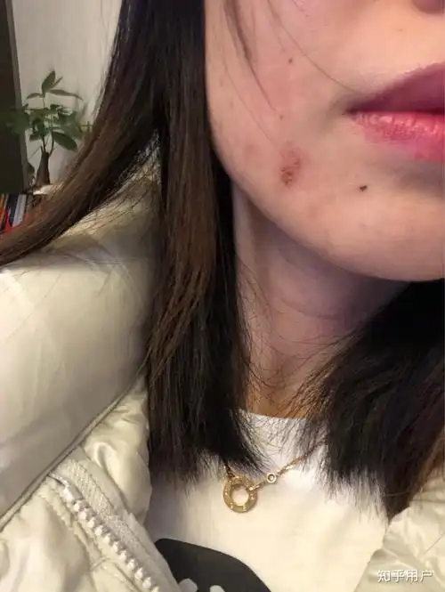 呜呜呜呜有没有做过果酸换肤的姐妹第一次做完果酸换肤第二天就结痂