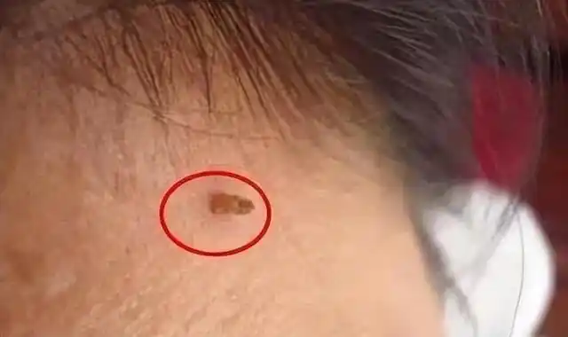 第一,腋下有小肉粒有可能是是软纤维瘤,很多正常人都有的,不必处理.