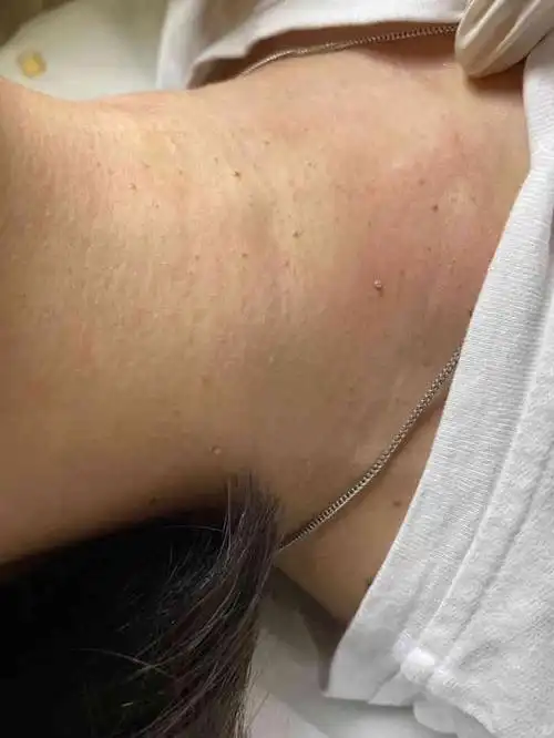 艾甄颜祛痘扁平疣修复中心直营店-"脖子上的疣着实困扰我很久了,看到