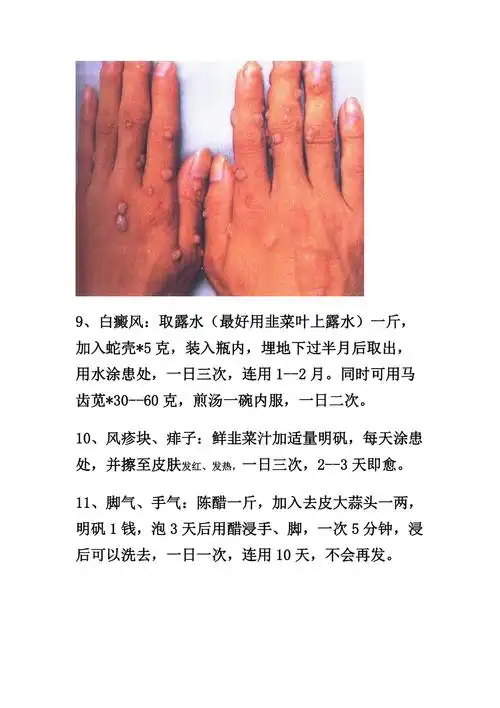 牛皮癣湿疹皮炎等各种皮肤病的偏方秘方大全