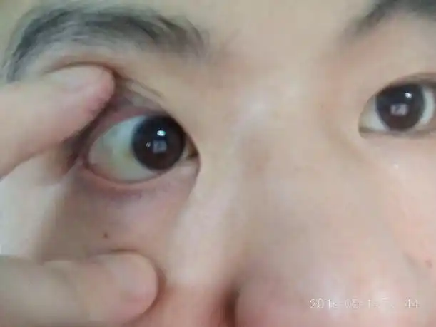 眼睛里有斑块,眼白发蓝,小时候得过溶血性贫血,吃蚕豆引起的,请问眼白