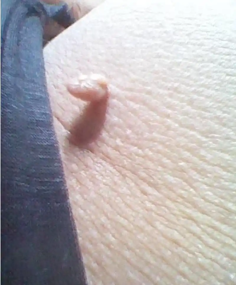 脖子上长肉疙瘩,这样处理简单有效  有些人脖子上会长一些小肉丁,不疼