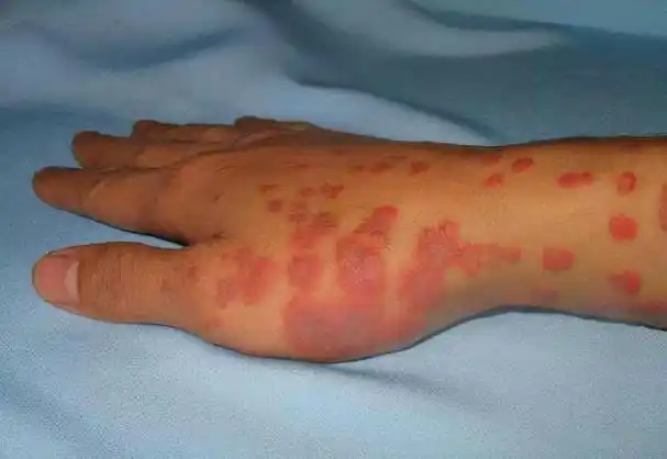 回顾女子去医院打退烧针几天后全身长红疹院方声明没有责任