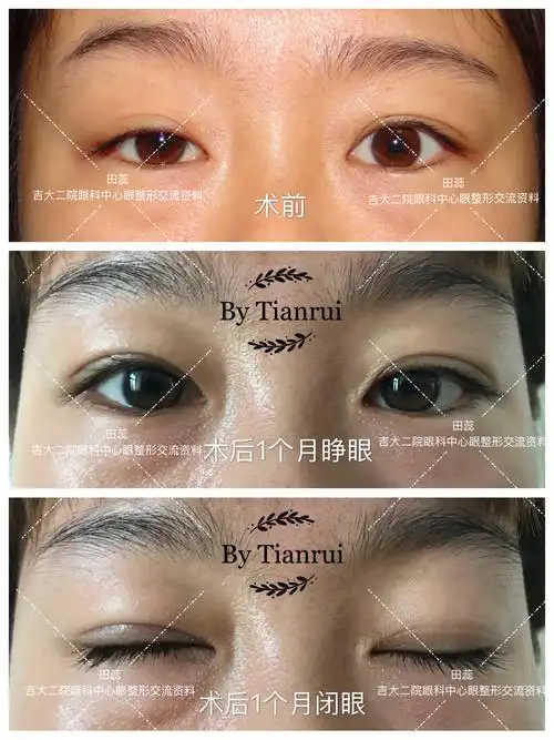 上睑下垂患者的术前术后对比图片 - 好大夫在线