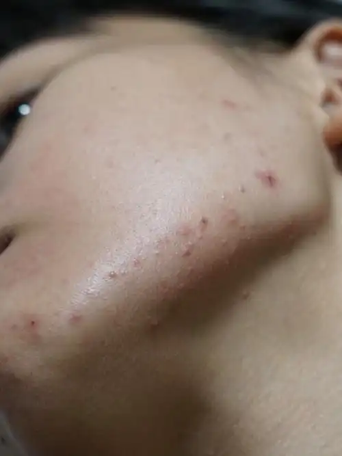 密恐了,长了一下颌的闭口