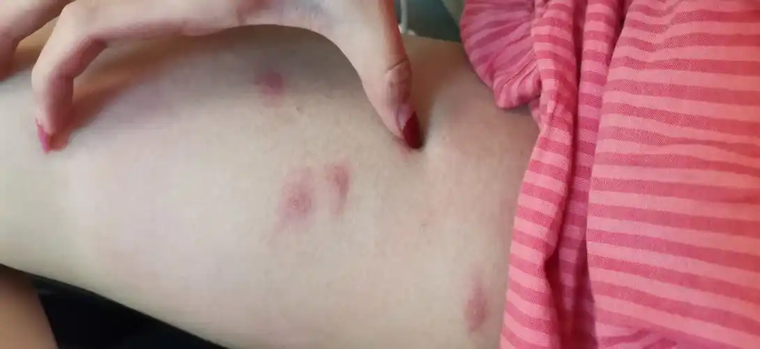 被跳蚤咬的全身都是包是什么样的感受! - 知乎