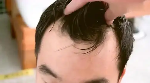 m型发际线两个角怎么补,天津熙朵李会民植发要怎么植?