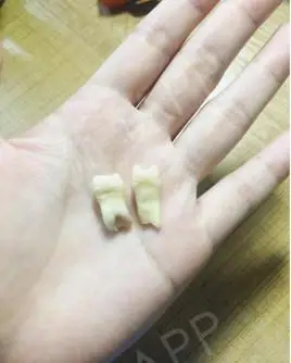 虎牙拔掉后凹陷的图片小孩拔出的牙小孩拔虎牙图片拔下来的虎牙7岁