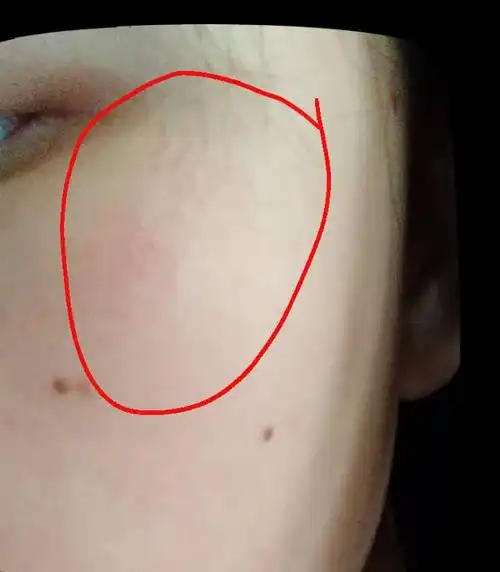 眼睛旁边长了很多疙瘩 红红的 以前都没有 就最近两天 图片看不太出来