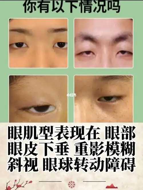 眼肌型眼睑下垂的出现有哪些原因?