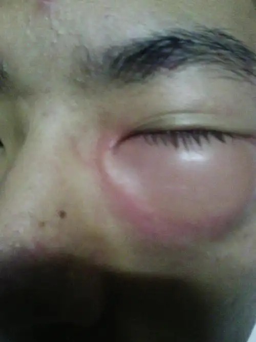 晚上去踢完球,眼睛肿了,真的超级肿.可能是蚊子叮了,怎么办?有图