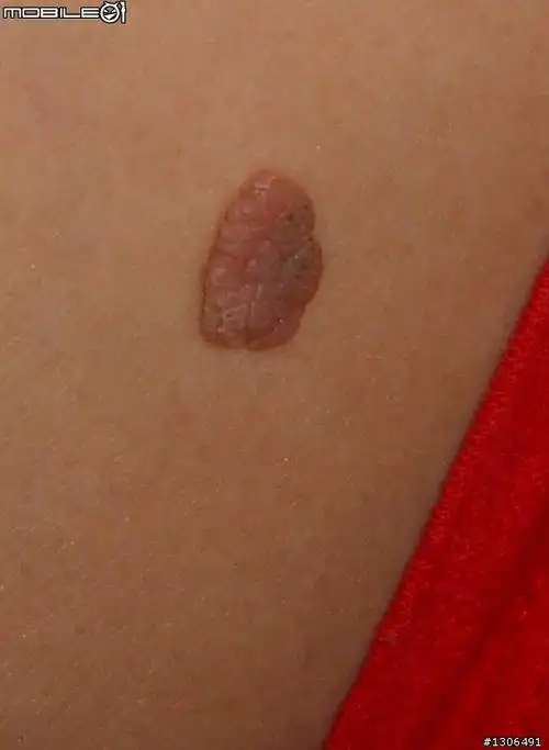 脸上身上长小肉球/小肉芽/肉瘤,这样就能治愈去除掉!简单得很!