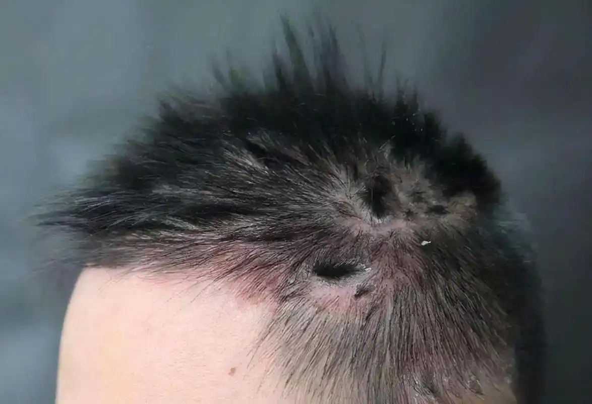 头部脂溢性皮炎图片(头皮上长出的脓包与疙瘩是什么物质) - 赤虎壹号