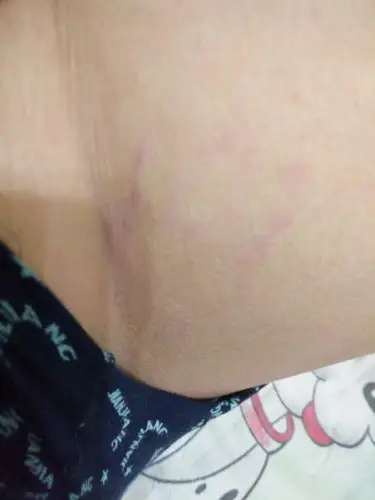 请问为什么我的大腿内侧有一些红色的斑点,有时还特别痒,出现了2个月