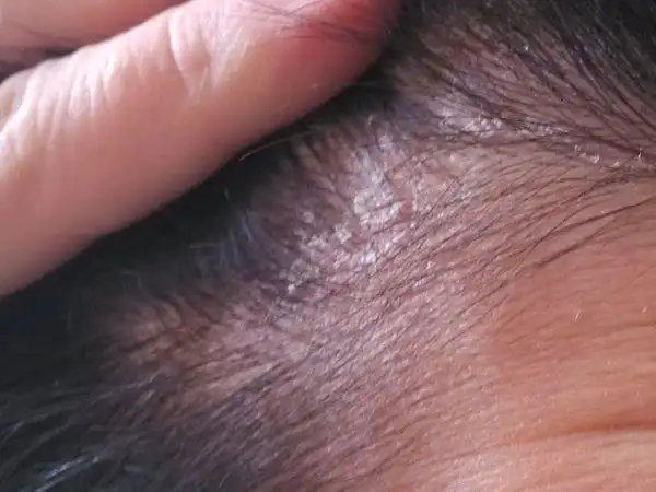 关于头皮干燥脱皮的问题,请高手支招,采纳后在追加20分!