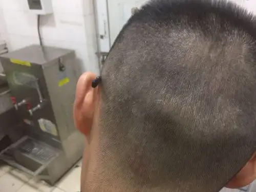 头皮痒,而且用洗发水洗完会出现很多头屑,头皮上有小痘痘发红