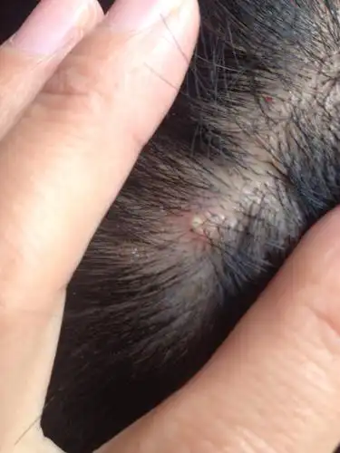 我的头皮上经常会起这样的白色泡泡,手一抓就破了,还很疼,很像脸上的