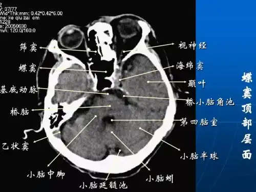 影像总结头颅ct基本知识与常见病变