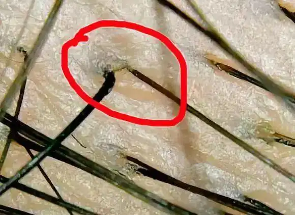治脱发,这5个毛囊问题必须得了解!