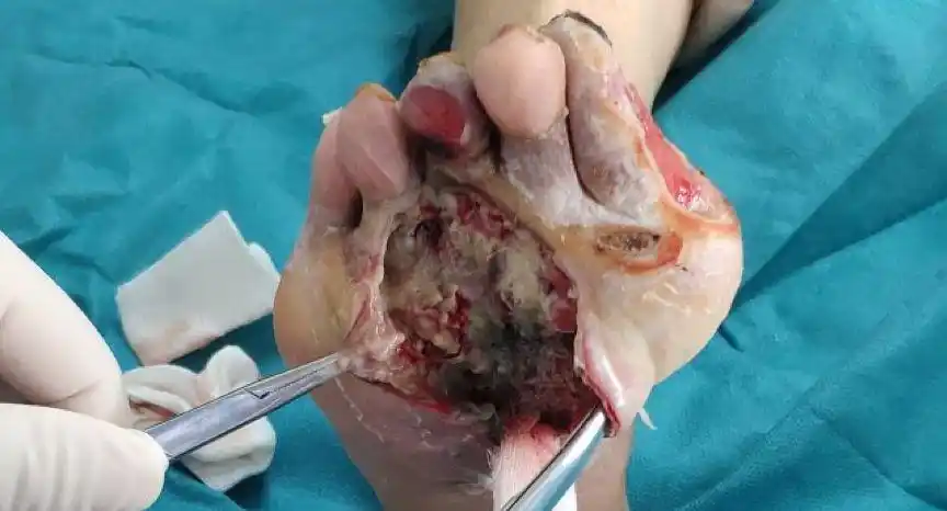 严重感染的糖尿病足险遭截肢最后一个足趾都不少这样处理最有效