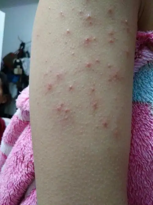 怀孕五个月患有毛囊炎,可以用白醋搽洗患处或则洗澡吗?