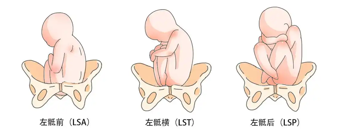 lsa胎位图是什么样的 lsa胎位风险大吗?