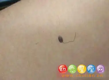 因为这个痣上面长毛称之为毛痣,是有福气的象征,要是你不信这个,就