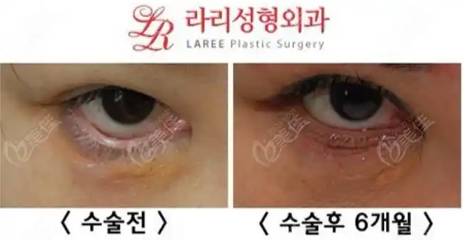韩国来丽下眼睑外翻修复前后图片对比