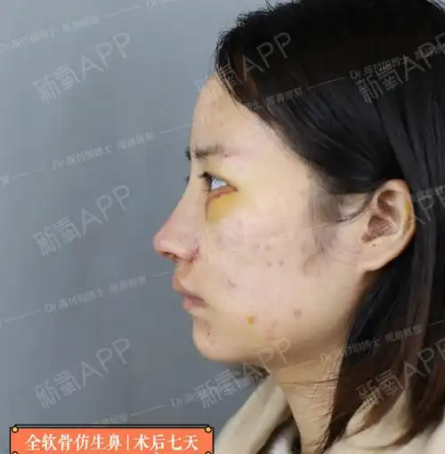 [:13]"binder综合症"又称先天性中面部凹_圈子-新氧美容整形