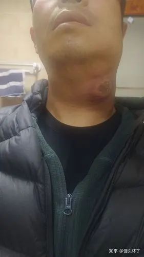 非霍奇金淋巴瘤弥漫大b细胞淋巴瘤抗瘤日志用药费用禁食减少身体不适