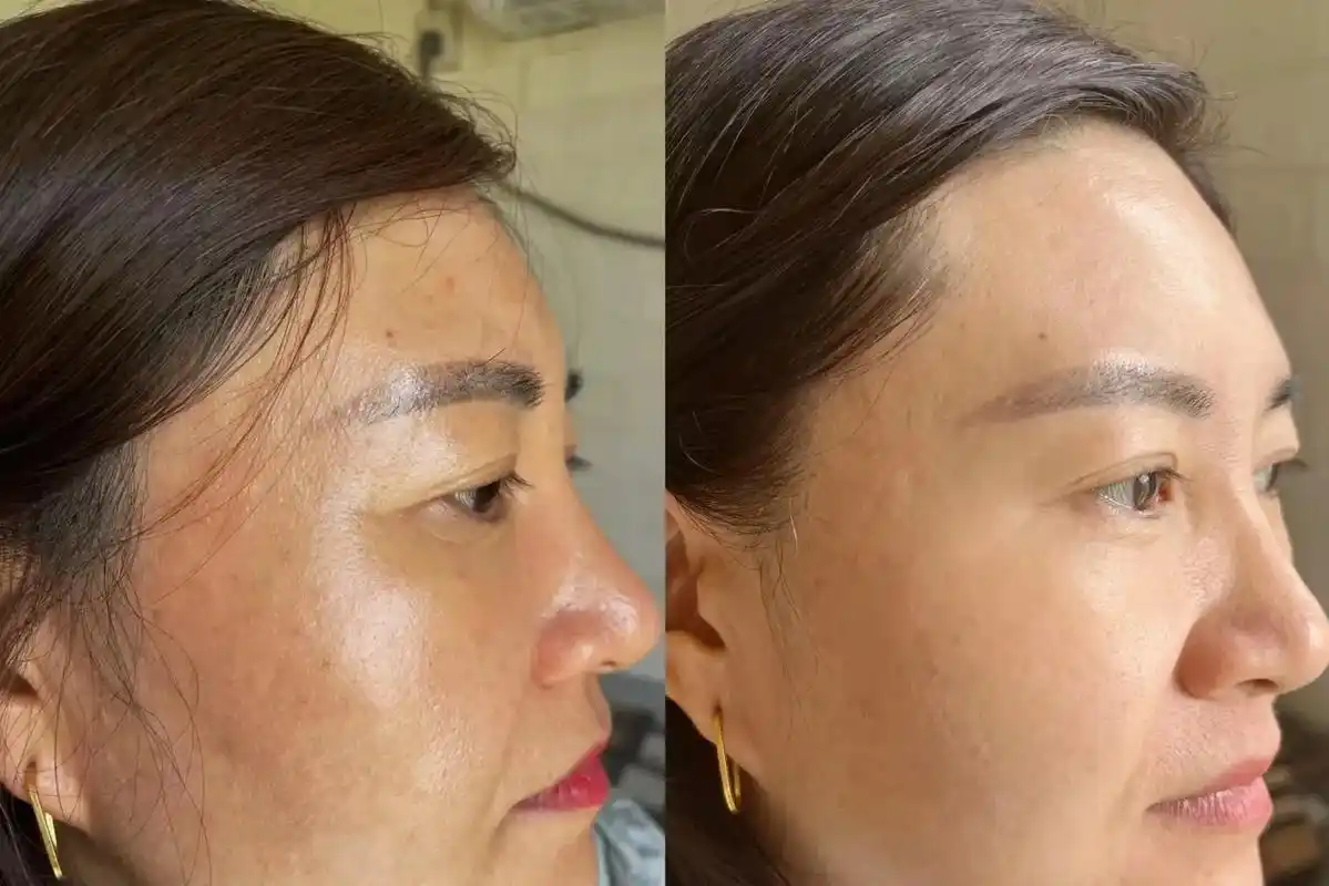 皮肤色素暗沉.#蒙嫒皮肤色素管理记录#美白淡斑 #今天你发什 - 抖音