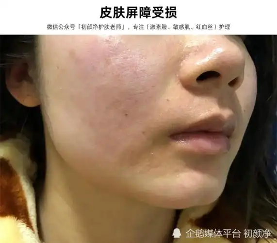 激素脸大多都是作出来的,皮肤9个异样早就告诉你,皮肤屏障受损了!