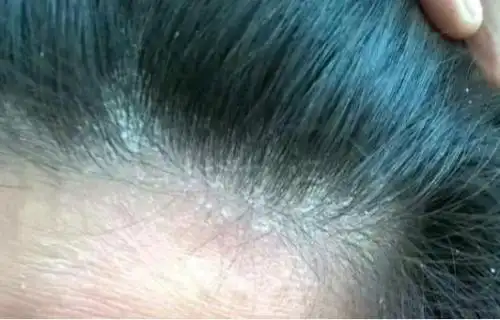 头皮瘙痒难忍用手指一抓全都是白泥几种迹象都不正常